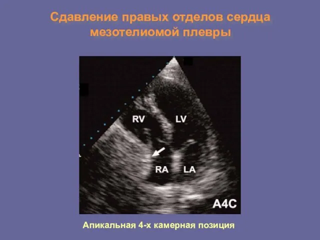 Сдавление правых отделов сердца мезотелиомой плевры Апикальная 4-х камерная позиция