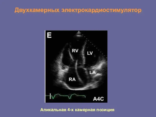 Двухкамерных электрокардиостимулятор Апикальная 4-х камерная позиция