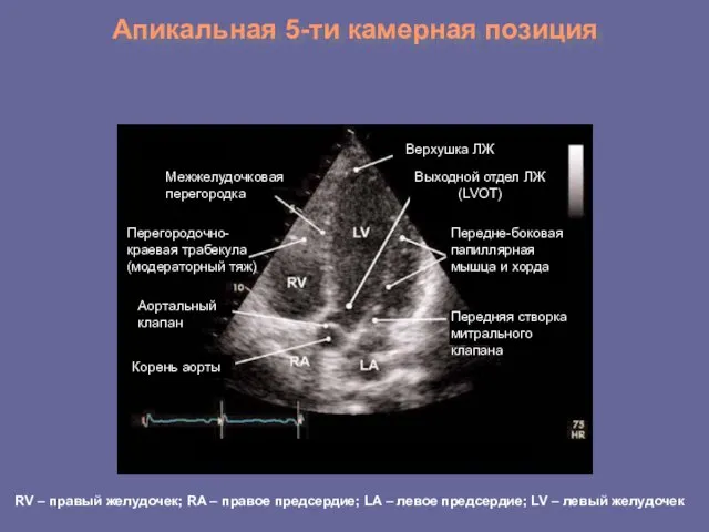 Апикальная 5-ти камерная позиция Межжелудочковая перегородка Перегородочно-краевая трабекула (модераторный тяж)