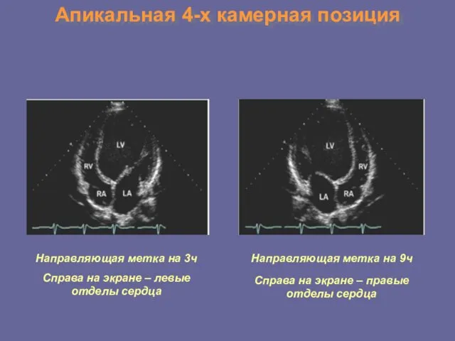 Апикальная 4-х камерная позиция Направляющая метка на 3ч Справа на