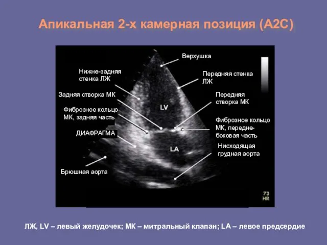 Апикальная 2-х камерная позиция (А2С) Верхушка Передняя стенка ЛЖ Передняя