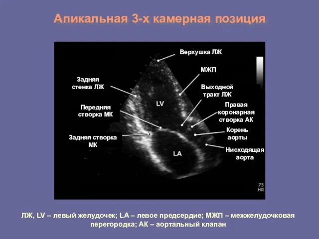 Апикальная 3-х камерная позиция Задняя стенка ЛЖ Передняя створка МК