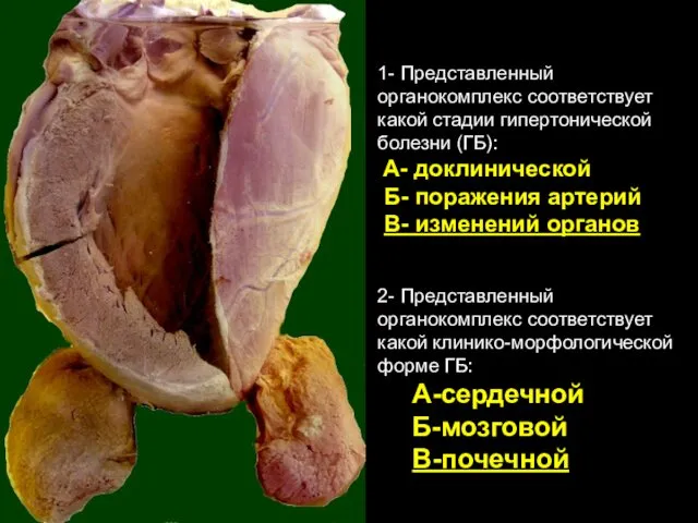 1- Представленный органокомплекс соответствует какой стадии гипертонической болезни (ГБ): А-