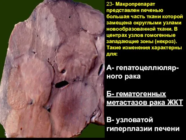 23- Макропрепарат представлен печенью большая часть ткани которой замещена округлыми