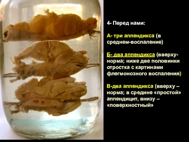 4- Перед нами: А- три аппендикса (в среднем-воспаление) Б- два