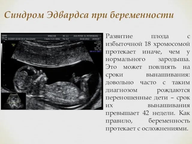 Синдром Эдвардса при беременности Развитие плода с избыточной 18 хромосомой