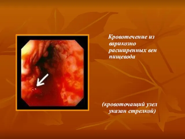 Кровотечение из варикозно расширенных вен пищевода (кровоточащий узел указан стрелкой)