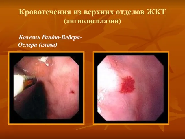 Кровотечения из верхних отделов ЖКТ (ангиодисплазии) Болезнь Рандю-Вебера- Ослера (слева)