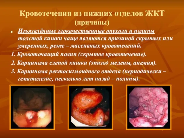 Кровотечения из нижних отделов ЖКТ (причины) Изъязвлённые злокачественные опухоли и полипы толстой кишки