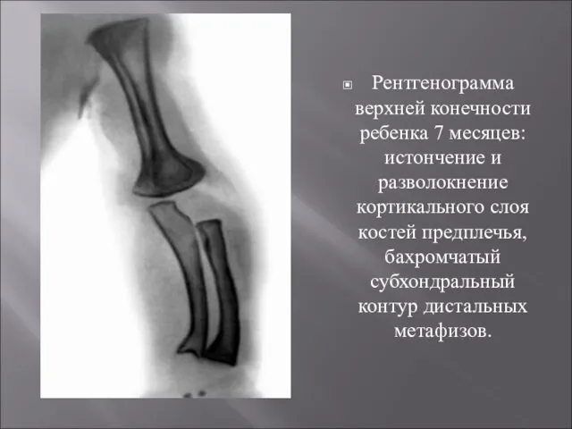 Рентгенограмма верхней конечности ребенка 7 месяцев: истончение и разволокнение кортикального