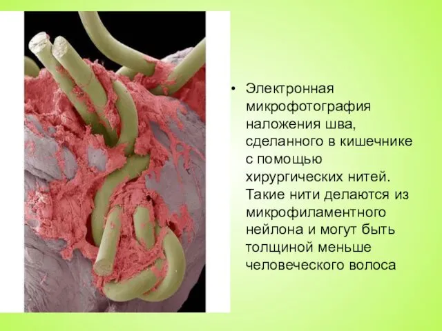 Электронная микрофотография наложения шва, сделанного в кишечнике с помощью хирургических