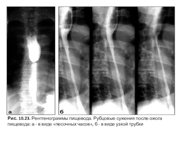 Рис. 10.23. Рентгенограммы пищевода. Рубцовые сужения после ожога пищевода: а