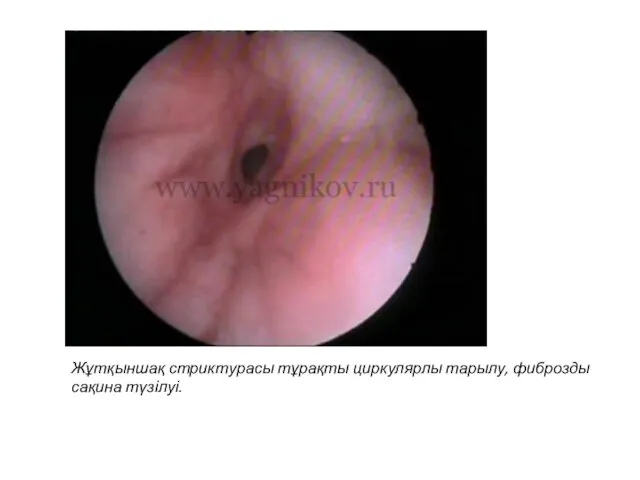 Жұтқыншақ стриктурасы тұрақты циркулярлы тарылу, фиброзды сақина түзілуі.