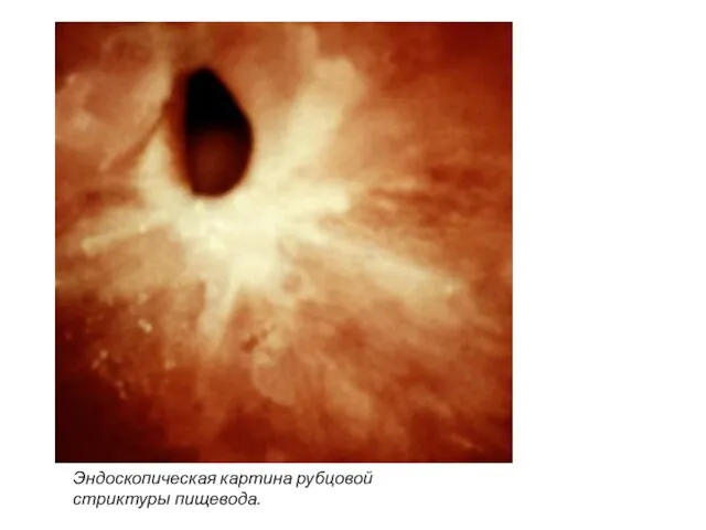Эндоскопическая картина рубцовой стриктуры пищевода.