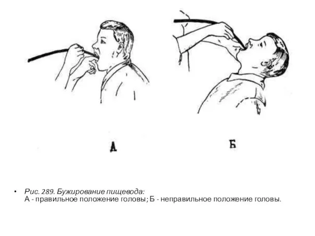 Рис. 289. Бужирование пищевода: А - правильное положение головы; Б - неправильное положение головы.