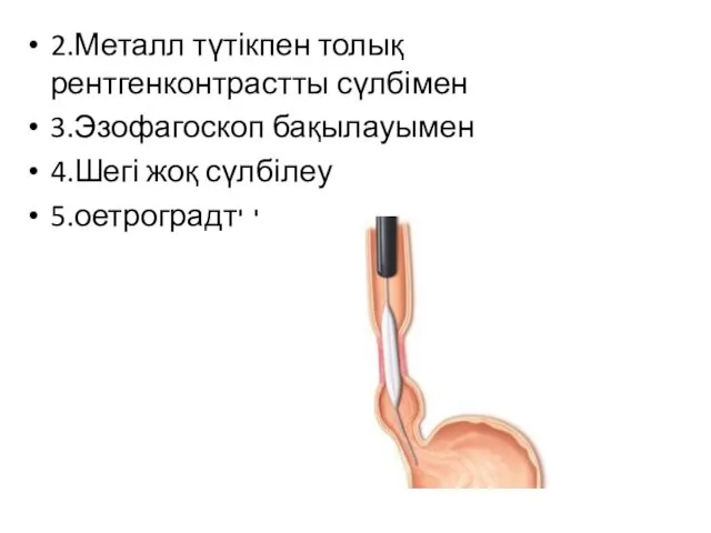 2.Металл түтікпен толық рентгенконтрастты сүлбімен 3.Эзофагоскоп бақылауымен 4.Шегі жоқ сүлбілеу 5.оетроградты