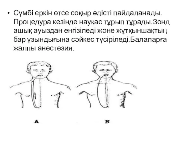 Сүмбі еркін өтсе соқыр әдісті пайдаланады.Процедура кезінде науқас тұрып тұрады.Зонд