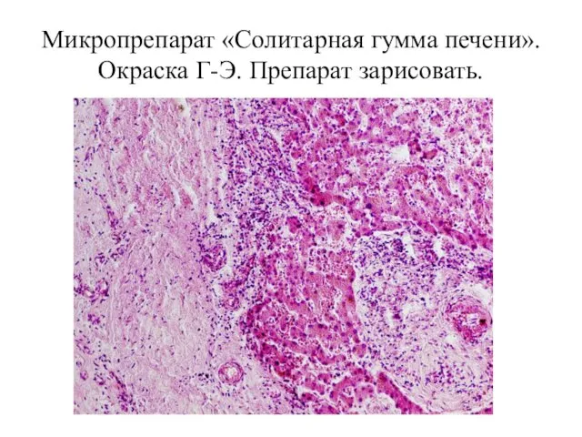 Микропрепарат «Солитарная гумма печени». Окраска Г-Э. Препарат зарисовать.