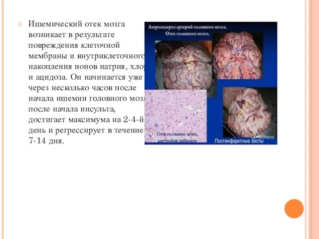 Ишемический отек мозга возникает в результате повреждения клеточной мембраны и