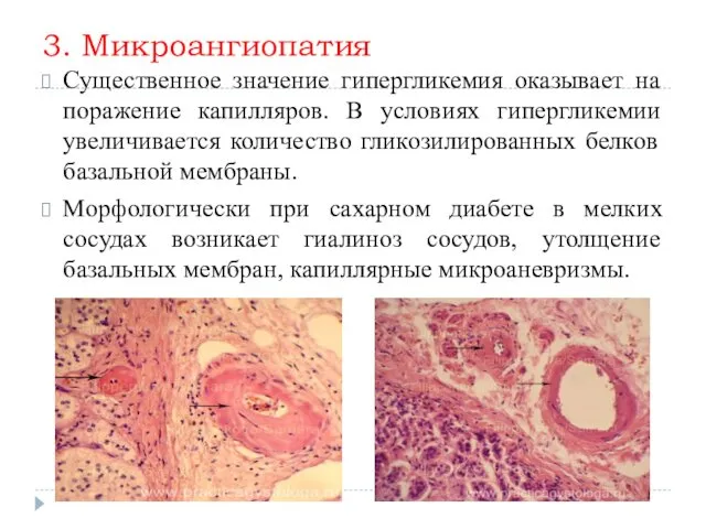 3. Микроангиопатия Существенное значение гипергликемия оказывает на поражение капилляров. В