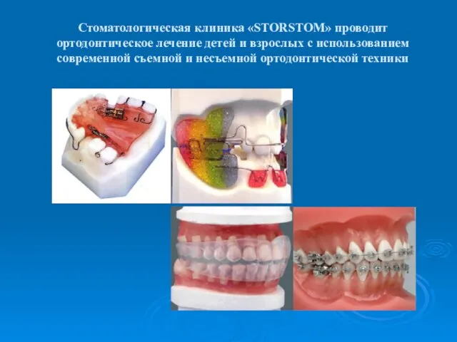 Стоматологическая клиника «STORSTOM» проводит ортодонтическое лечение детей и взрослых с использованием современной съемной