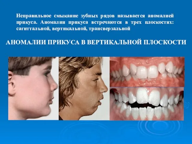 Неправильное смыкание зубных рядов называется аномалией прикуса. Аномалии прикуса встречаются в трех плоскостях: