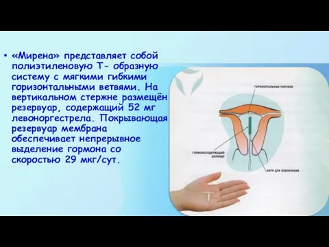 «Мирена» представляет собой полиэтиленовую Т- образную систему с мягкими гибкими