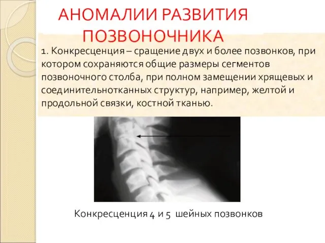 Конкресценция 4 и 5 шейных позвонков 1. Конкресценция – сращение