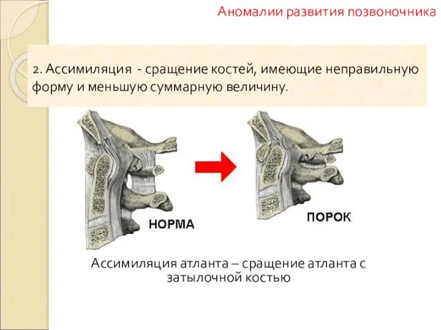 Ассимиляция атланта – сращение атланта с затылочной костью Аномалии развития