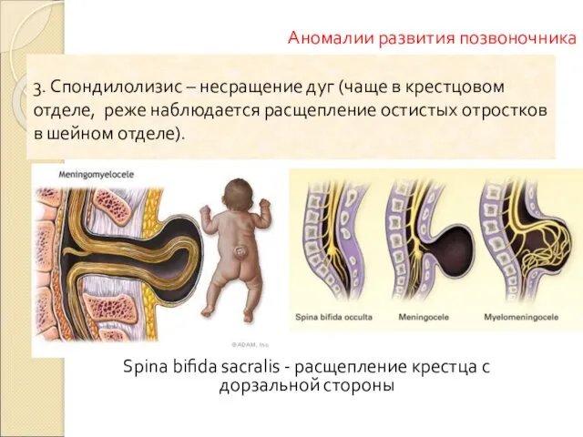 Spina bifida sacralis - расщепление крестца с дорзальной стороны Аномалии