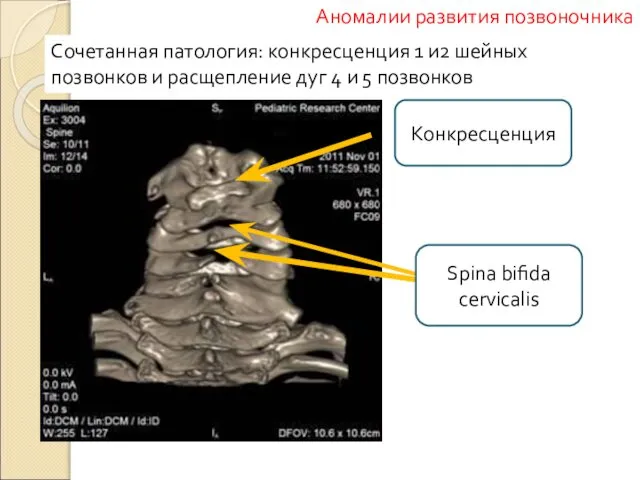 Сочетанная патология: конкресценция 1 и2 шейных позвонков и расщепление дуг