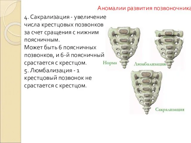 Аномалии развития позвоночника 4. Сакрализация - увеличение числа крестцовых позвонков