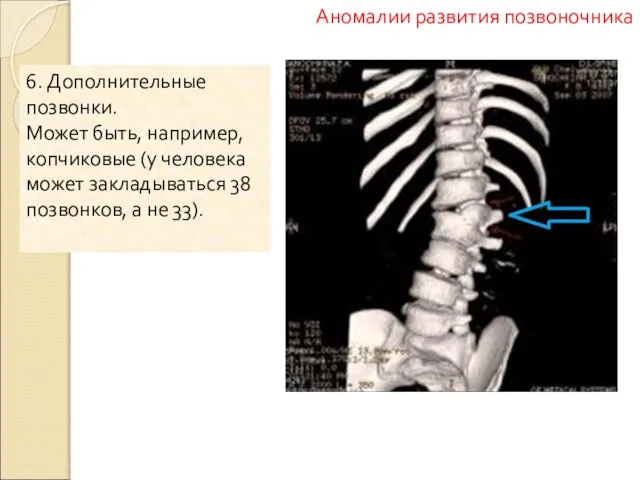 6. Дополнительные позвонки. Может быть, например, копчиковые (у человека может