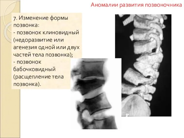 7. Изменение формы позвонка: - позвонок клиновидный (недоразвитие или агенезия