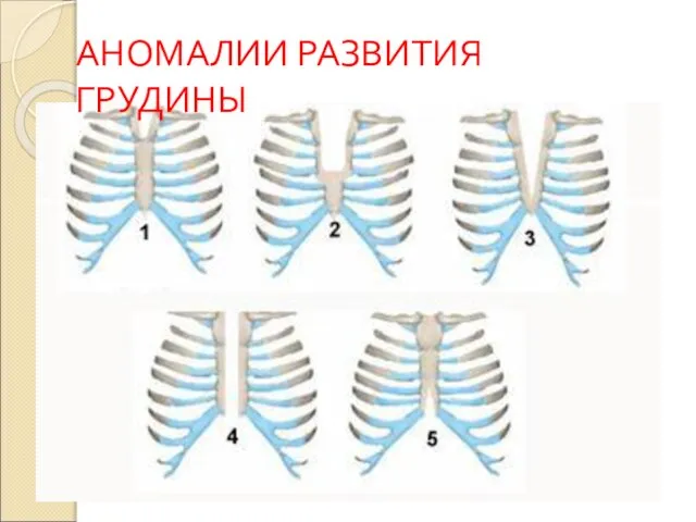 АНОМАЛИИ РАЗВИТИЯ ГРУДИНЫ