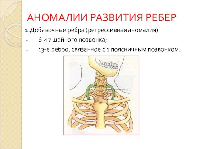 АНОМАЛИИ РАЗВИТИЯ РЕБЕР 1.Добавочные рёбра (регрессивная аномалия) 6 и 7