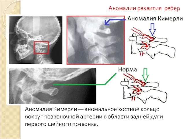 Аномалия Кимерли — аномальное костное кольцо вокруг позвоночной артерии в