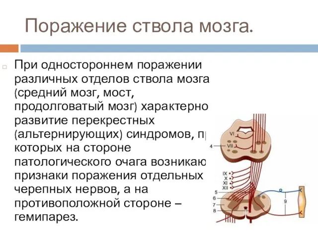 Поражение ствола мозга. При одностороннем поражении различных отделов ствола мозга