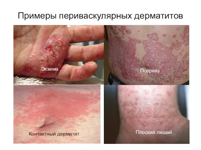 Примеры периваскулярных дерматитов Экзема Контактный дерматит Псориаз Плоский лишай