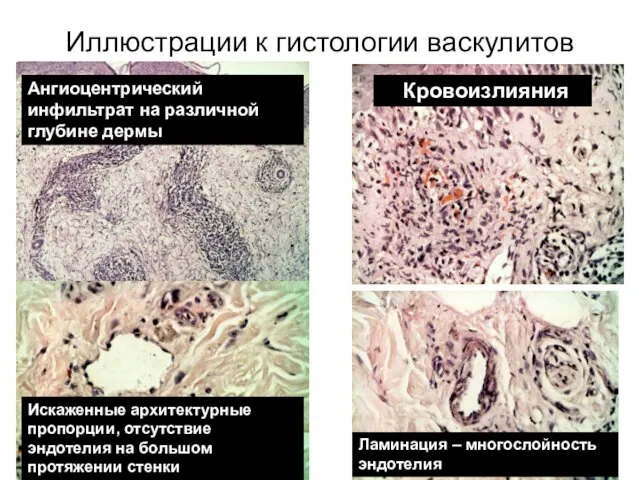 Иллюстрации к гистологии васкулитов Ангиоцентрический инфильтрат на различной глубине дермы Кровоизлияния Искаженные архитектурные
