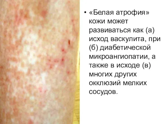 «Белая атрофия» кожи может развиваться как (а) исход васкулита, при (б) диабетической микроангиопатии,