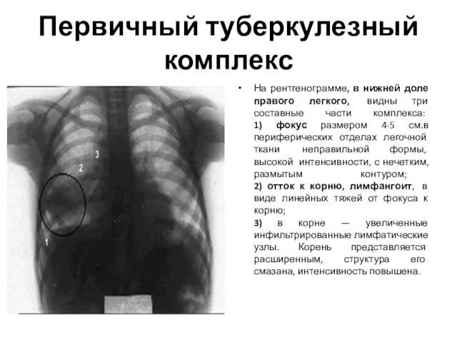 Первичный туберкулезный комплекс На рентгенограмме, в нижней доле правого легкого,