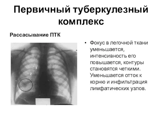 Первичный туберкулезный комплекс Рассасывание ПТК Фокус в легочной ткани уменьшается,