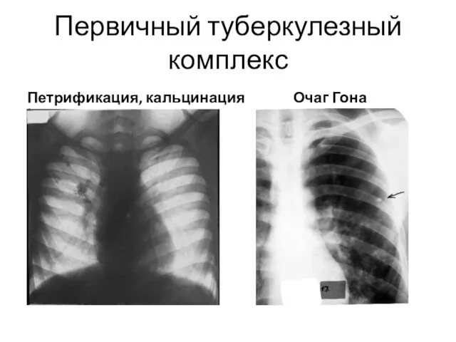 Первичный туберкулезный комплекс Петрификация, кальцинация Очаг Гона