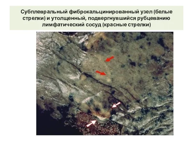 Субплевральный фиброкальцинированный узел (белые стрелки) и утолщенный, подвергнувшийся рубцеванию лимфатический сосуд (красные стрелки)