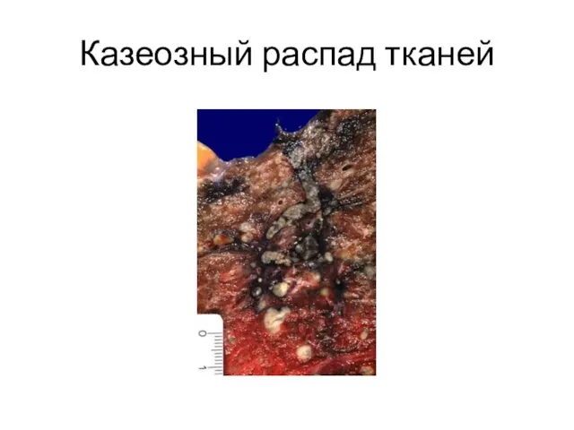 Казеозный распад тканей