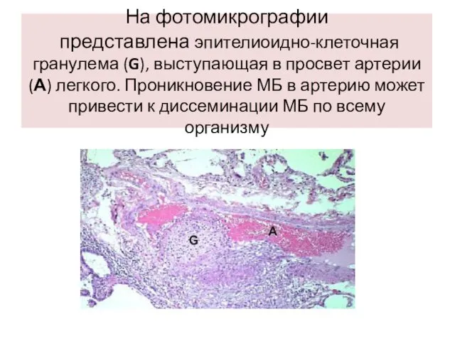 На фотомикрографии представлена эпителиоидно-клеточная гранулема (G), выступающая в просвет артерии