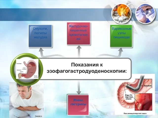 Опухоли, полипы желудка Желудочно-кишечные кровотечения Варикозные узлы пищевода