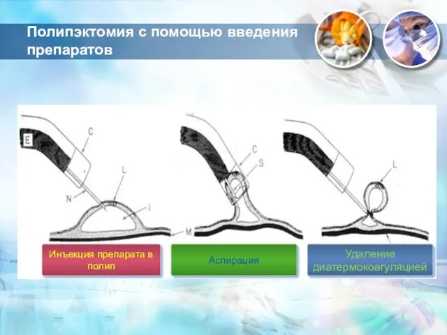 Полипэктомия с помощью введения препаратов Аспирация Инъекция препарата в полип Удаление диатермокоагуляцией