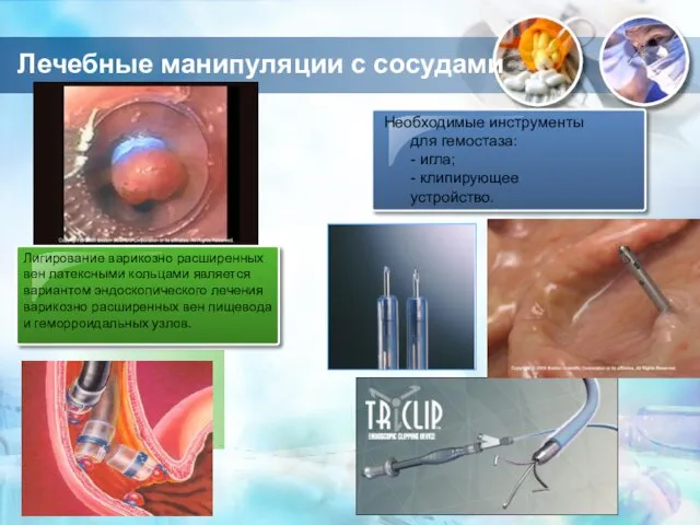 Необходимые инструменты для гемостаза: - игла; - клипирующее устройство. Лигирование